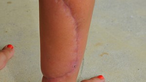 Shark bite? How experts identify bites from sharks, toothy creatures, barracuda, bluefish