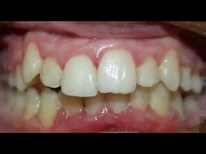 14K views · 43 reactions | Monthly Changes/ Movements with K Line Aligners K Clear Aligners. 100% designed and fabricated in Germany. Invisible, high quality and effective. Visit us today for a FREE K Line Consultation! #kclear #klineeurope #KLinePH #clearaligner #aligner #aligners #clear #clearaligners #orthodontics #orthodontist #dentist #dentistry #straightteeth #smile | UDC - Uy Dental Clinic Group | Facebook