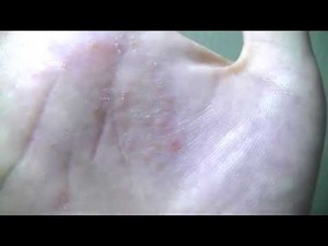 汗疱状湿疹の水泡をステロイド軟膏で治療解説します