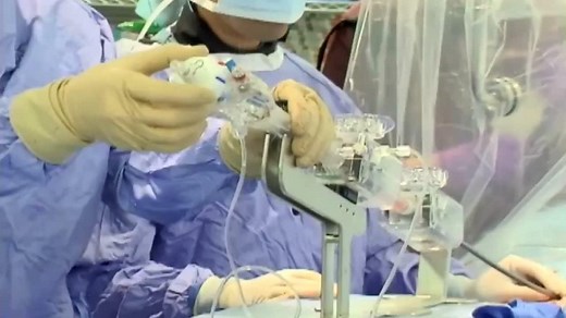 Overview of the MitraClip