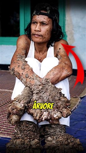 The Tree Man: The World's Rarest Disease! 🌳 - Dede Koswara #curiosities #news #brazil