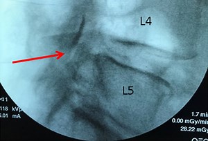 Ligamentum Flavum & Low Back Pain