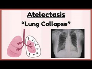 Atelectasis | Lung Collapse