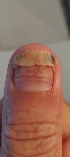 step by step recovery in 25 weeks of thumb nail injury #nails
