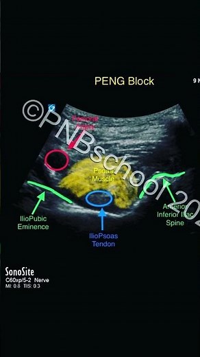 Ultrasound Guided PENG and LFCN Block for Total Hip Replacement #Anesthesia #CRNA #nerveblock #SRNA