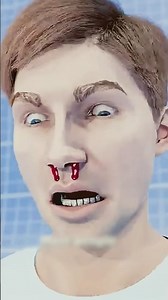 Nosebleed? Do THIS Before It’s Too Late! 🚨 #HealthHack"