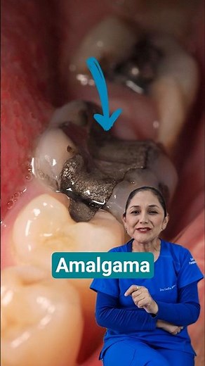 Amalgama dental: ¿Aún se usan?