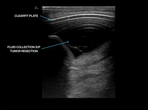 4x5cm Superficial fluid collection video
