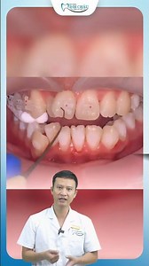 Revealing the Standard Medical Procedure for Attaching Braces | Doctor Yen