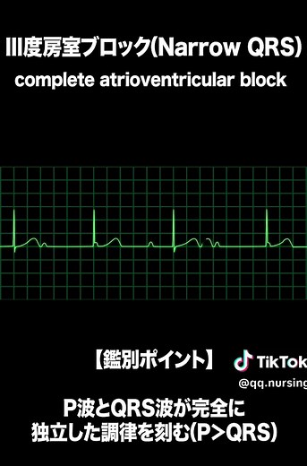 今回は房室ブロックの波形を洞調律からⅢ度房室ブロックまで流れで見てみましょう！流れで見ることで、房室ブロックではP波は脱落しないんだなぁ…という特徴がよくわかるかと思います！そして徐々にヤバさが増していくことがよくわかるかと思います！ このような動画を少しづつ増やしていこうかな…と考え中なので、こんな波形が見たい！などリクエストがあればコメントに書いていただけると嬉しいです！ #心電図 #心電図検定 #看護師 #新人看護師 #看護師の勉強垢 #ecg #ekg #房室ブロック 【お知らせ】 ★SNS発信や勉強会、自己学習に最適なオリジナルの心電図アニメーション販売中！ ★心電図苦手を克服したい方へ向けた「モニター心電図 はじめの一歩(PDF資料)」販売中！ →→→詳細はプロフィール@qq.nursingのリンクかハイライトをご確認ください！