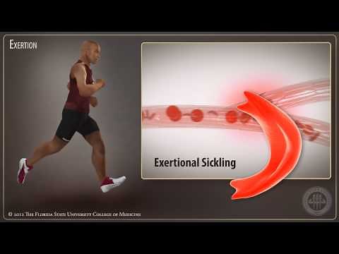 Sickle Cell Trait- Exertional Sickling in Athletes