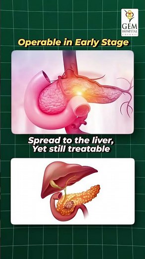 Steve Jobs: The Truth About His Pancreatic Condition