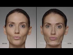 Restylane Before and After Video