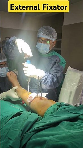 External Fixator In Tibia #Compound grade IIIb injury Tibia fibula fracture #orthopaedic #hospital