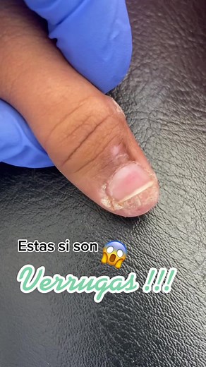 Cómo tratar mezquinos en manos y dedos