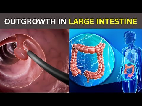 Colon Polypectomy | Removal Of Polyps From Large intestine