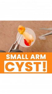 THE DOC•Adarsh Vijay Mudgil MD on Instagram: "⁣ ⁣ Here’s a fun little cyst we recently removed from my wonderful patient’s arm. 😉⁣ ⁣ #pimplepopper #pimplepopping #drmudgil #nycdoctor #nycdermatologist #doctorsofinstagram ⁣"
