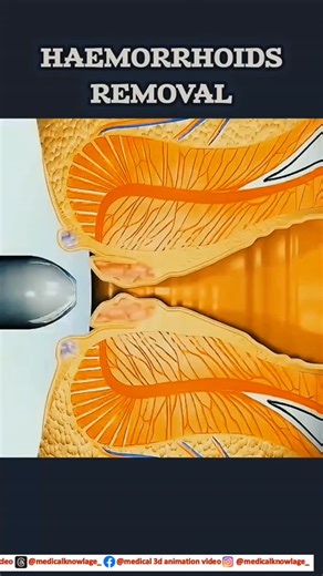 medical knowledge on Instagram: "Hemorrhoids removal surgery explained through 3D medical animation.See how the procedure works step by step — clear, safe, and effective. #Hemorrhoids #HemorrhoidsSurgery #PilesTreatment #MedicalAnimation #3DMedicalAnimation #SurgeryExplained #HealthEducation #MedicalReels #DoctorReels #HealthcareContent topfans medical 3d animation video #PatientAwareness"