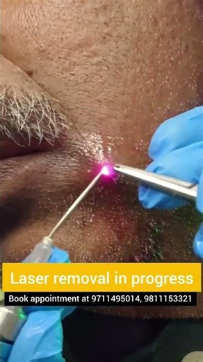 Remove Moles/ Skin tags with Laser: Bloodless, painless treatment; Dr. Srishti Bhatia