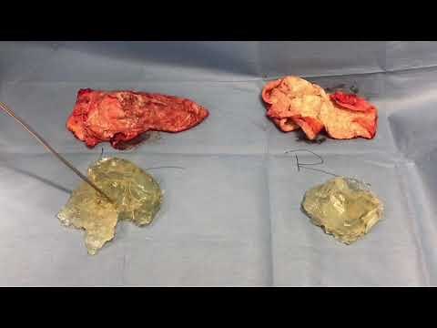 30 Year Old Breast Implants Removal *RUPTURED*