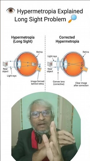 👁️ Hypermetropia Explained | Long Sight Problem & Convex Lens Correction 🔎 | Class 10 Physics