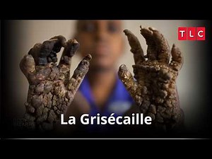 L'infection recouvrira bientôt tout son corps ! Body Bizarre