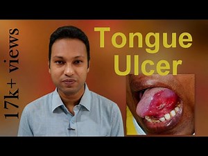 Tongue Ulcer: Aetiologies & Diagnostic Approach
