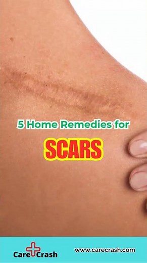 5 Natural Scars Home Remedies | #carecrash