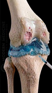 Visco-Gel Injections for Knee Arthritis Pain (Realistic 3D Animation) #KneeArthritis #ViscoGel