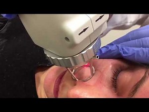 Fractional CO2 Laser Skin Resurfacing - Full Face!