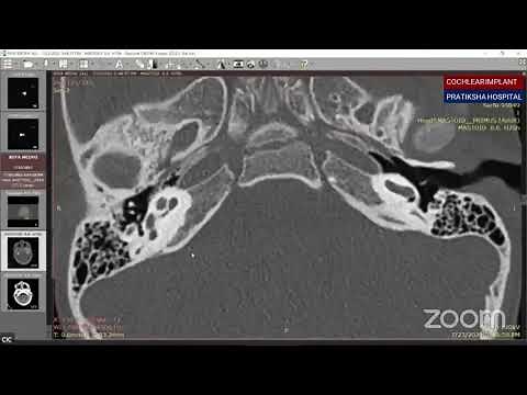 Radiology for Cochlear Implantation