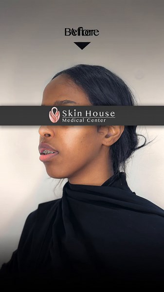 Non surgical face contour and receding chin correction using fillers. ✅Book your consultation now with our experienced doctors and get the transformation you deserve!🤩 Contact us on: 024433374 #recedingchin #uae #abudhabi #jawlinefiller #jawlinecontouring #chinfiller #explore #tajmeel #تجميل #ذقن_مزدوج #ذقن_متراجع #تحديدالفك #ابوظبي #الامارات