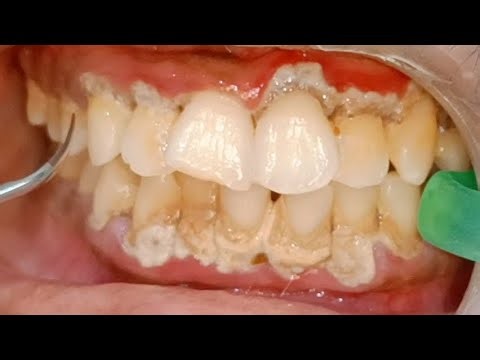 Dental Scaling of Tartar Affecting Gums Badly🤢🥵. Amazing Results after Plaque Removal. Dr Ram MDS