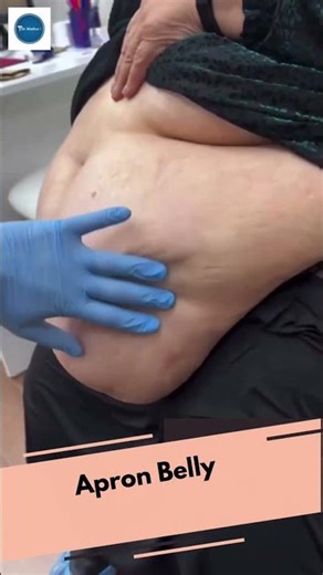 Apron Belly || #Surgery || #MedEd || #plasticsurgery || #Education ||