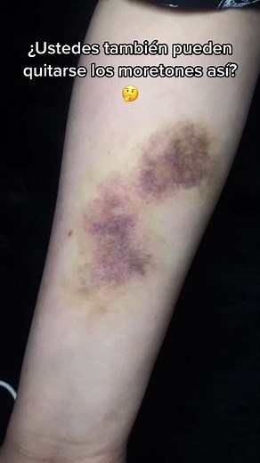 How to Remove Fake Bruises Quickly - Makeup Tips