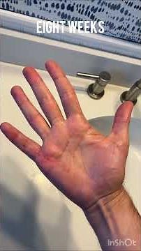 First Eight Weeks in One Minute: Recovery From Dupuytren’s Contracture Surgery [semi-graphic?]