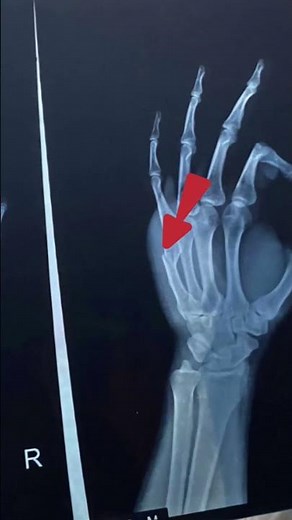 Boxer's fracture #medicosfactz #realpatientcase