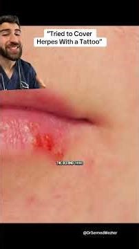 POV: You Cover Your Herpes