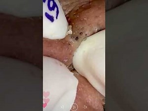 Skincare | Blackheads Removal #483 #tweezers skincare #blackheads blackheads