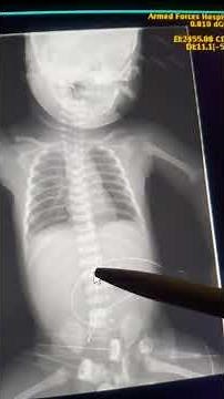 Case 286 location and complications of umblical catheter ,UVC low line, UAC proper position