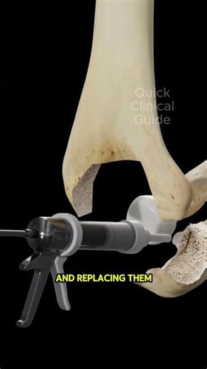 Elbow Replacement (Arthroplasty) #elbowpain #elbowsurgery