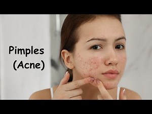 Pimples (Acne) and its types, Why do we get Pimples