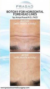 An Original Botox Doctor Explains How It Works #botox