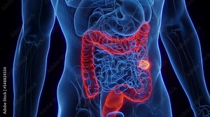 3d rendered medical animation of colon cancer in a male human's descending colon