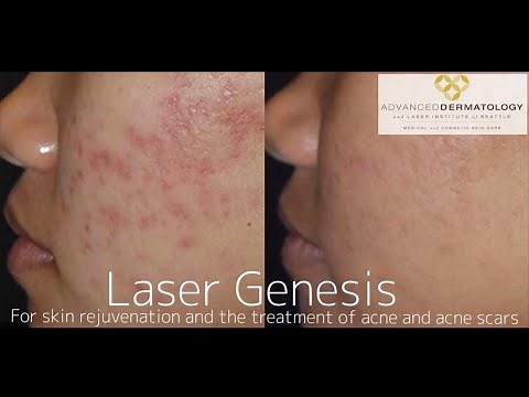 Laser Genesis Treatment at Advanced Dermatology & Laser Institute of Seattle
