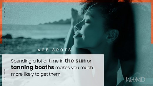 Age spots are most common after 50 -- but anyone can get them, even kids. | WebMD