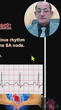Sick Sinus Syndrome (15)