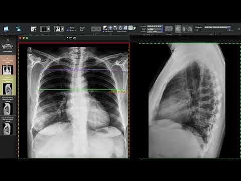 PNEUMONIA LOBAR NA RADIOGRAFIA DE TÓRAX