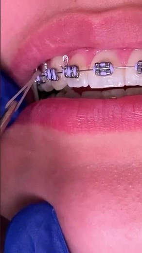 How do rubber bands work with braces? Tooth Time Family Dentistry New Braunfels Texas