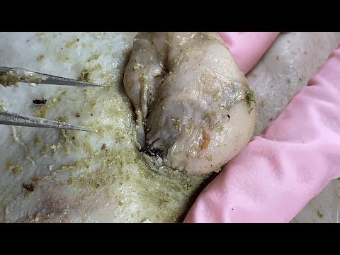 Most Satisfying ASMR Pimple Popping | Giant Zit & Blackhead Extraction Compilation KEM3108M40157